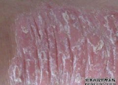 寻常型银屑病临床表现