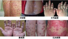 银屑病（牛皮癣）症状图
