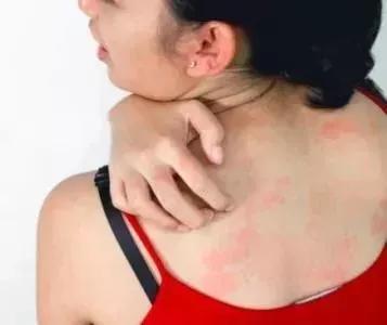 牛皮癣有哪些主要的隐性危害？ 该如何护理呢？
