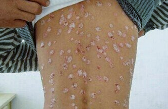 青少年牛皮癣怎么回事?牛皮癣治疗患者该如何积极的面对?