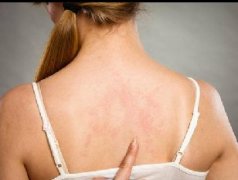 女性银屑病如何更好控制？