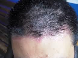 银屑病患者有哪些脱发的原因？