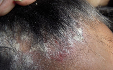 头部银屑病有哪些症状？导致它扩散的因素有哪些？
