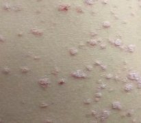 点滴型银屑病与花斑癣有何区别?