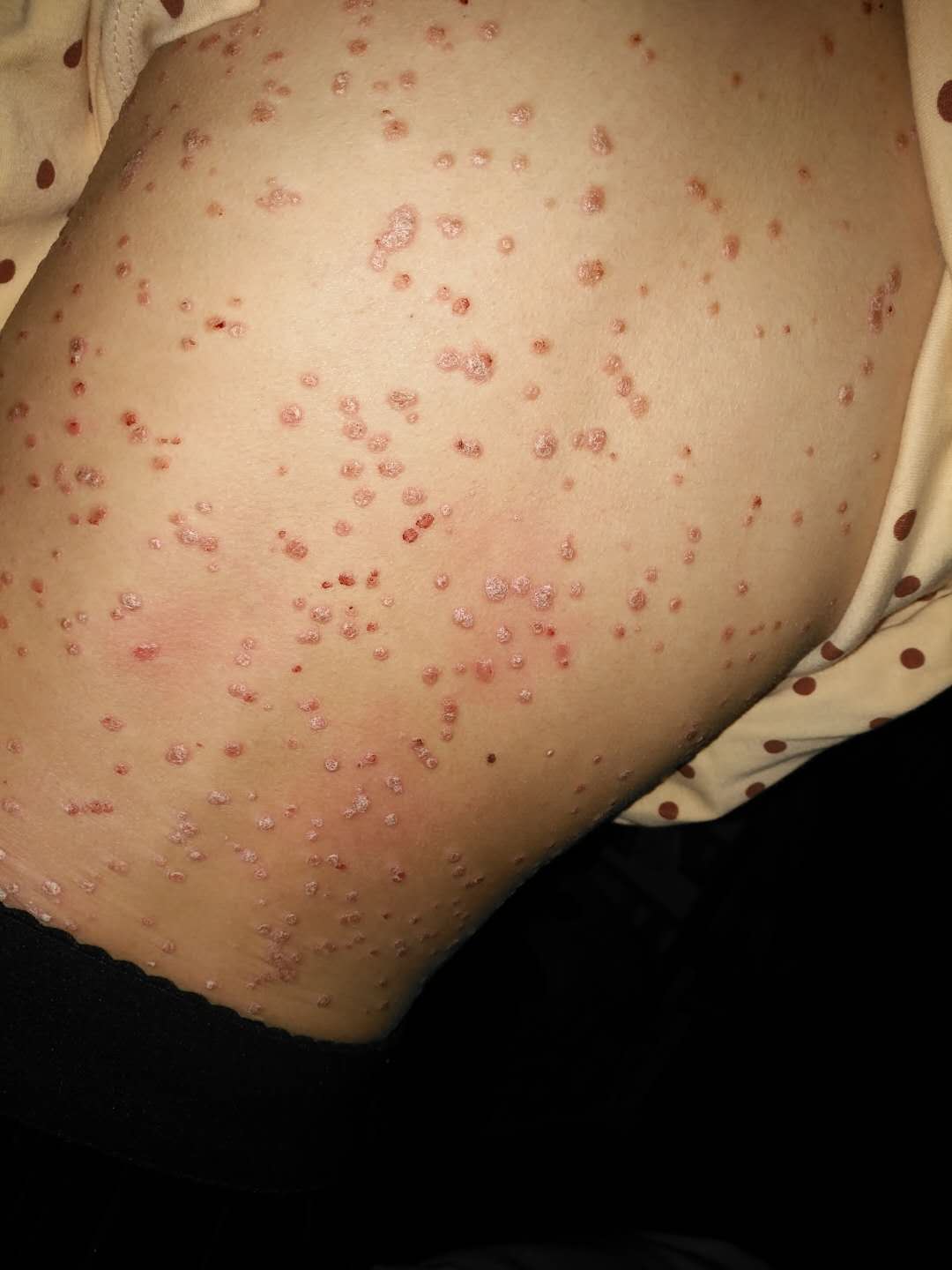 银屑病与癣的区别