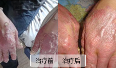 关节型牛皮癣该如何进行治疗