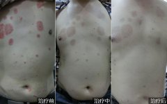胸部脓疱型银屑病的治疗