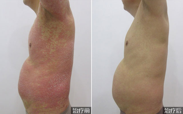 全身红皮型银屑病的治疗
