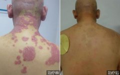 背部红皮型银屑病的治疗