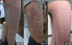 腿部寻常型银屑病的治疗