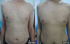 胸部寻常型银屑病的治疗