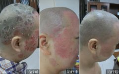 头部脓疱型银屑病的治疗