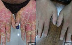手部关节病型银屑病的治疗
