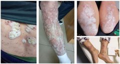 男性牛皮癣患者为何多于女性？