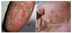 掌跖脓疱病症状是什么样的
