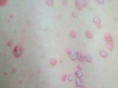 银屑病患者皮损扩散怎么办