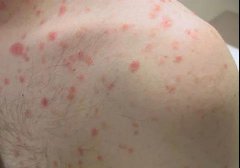 怎样防止点滴状银屑病扩散到全身都是