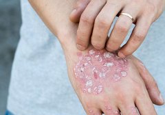 21世纪的银屑病最佳治疗方法